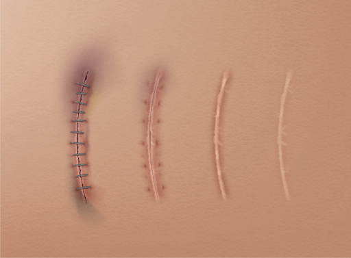 Surgical Incision Rebuilding Phase