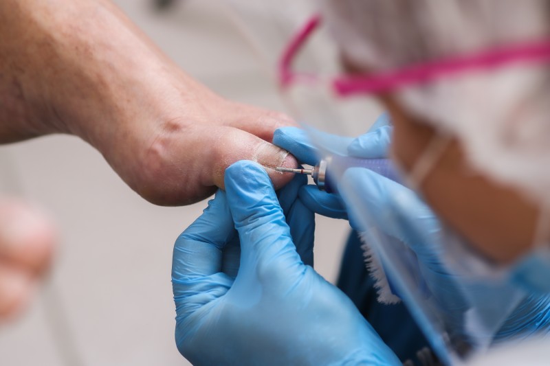 Caring For Your Feet After A Surgical Nail Removal