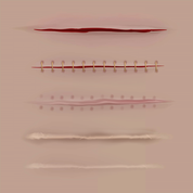 Surgical Incisions