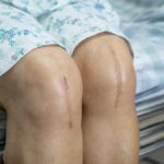 surgical scar