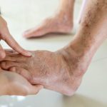 Examining the foot of a person with peripheral arterial disease