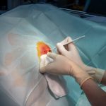 dead space in acute and chronic wounds