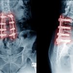 bone graft