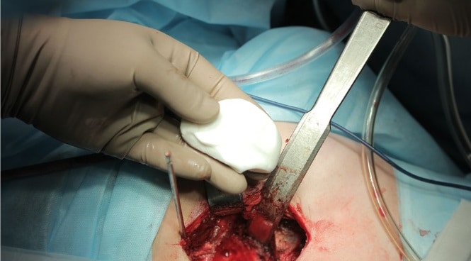 advanced surgical solution BIASURGE