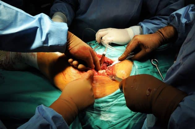 Intraoperative Wound Irrigation