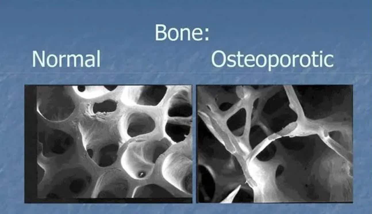 Normal Vs Osteoporotic Bone